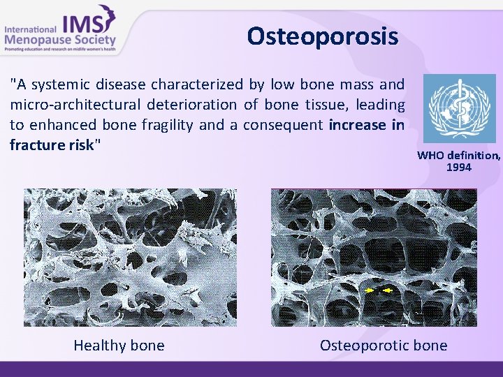 Osteoporosis "A systemic disease characterized by low bone mass and micro-architectural deterioration of bone Osteoporosis "A systemic disease characterized by low bone mass and micro-architectural deterioration of bone