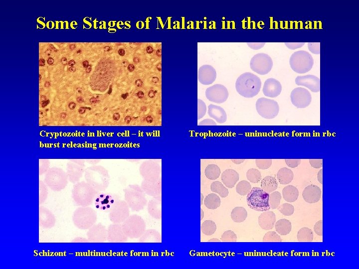 Some Stages of Malaria in the human Cryptozoite in liver cell – it will Some Stages of Malaria in the human Cryptozoite in liver cell – it will