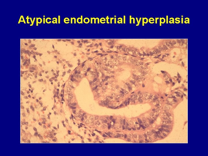 Atypical endometrial hyperplasia 