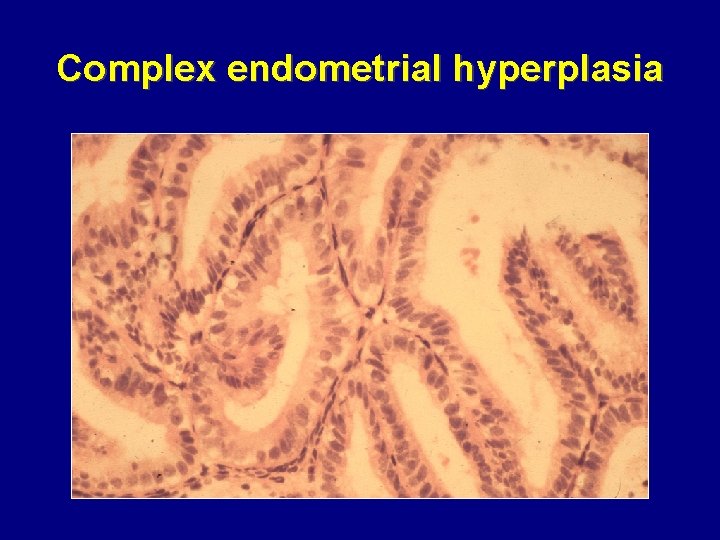 Complex endometrial hyperplasia 