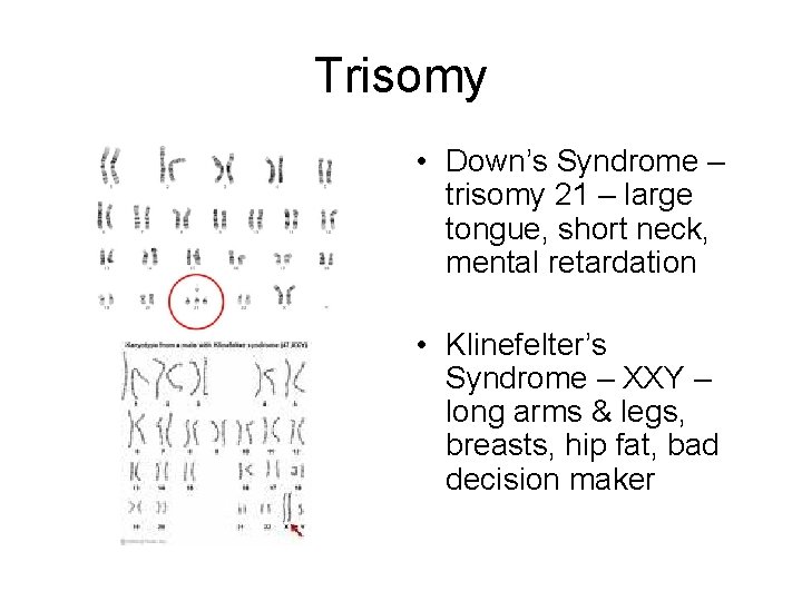 Trisomy • Down’s Syndrome – trisomy 21 – large tongue, short neck, mental retardation
