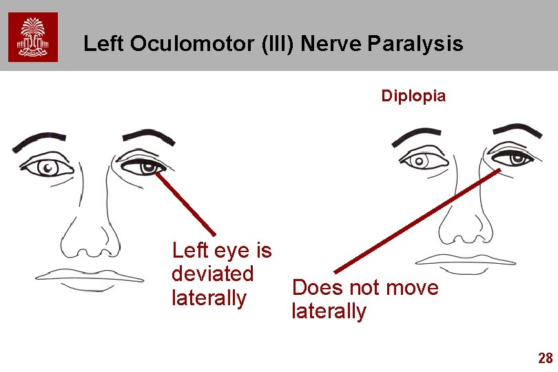 Left Oculomotor (III) Nerve Paralysis Diplopia Left eye is deviated Does not move laterally