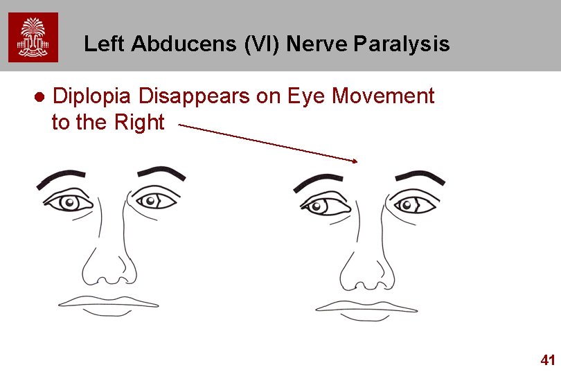 Left Abducens (VI) Nerve Paralysis l Diplopia Disappears on Eye Movement to the Right