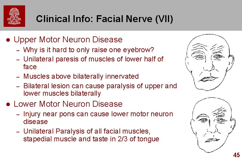 Clinical Info: Facial Nerve (VII) l Upper Motor Neuron Disease – – l Why