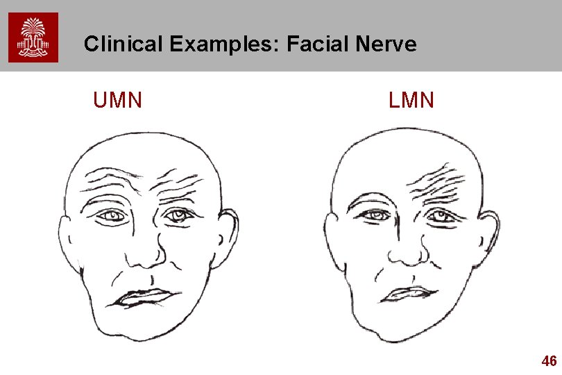 Clinical Examples: Facial Nerve UMN LMN 46 