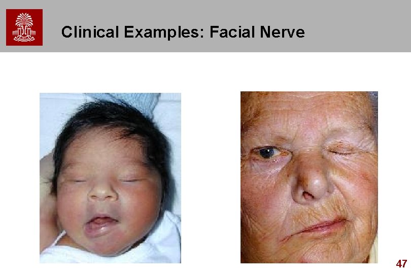 Clinical Examples: Facial Nerve 47 