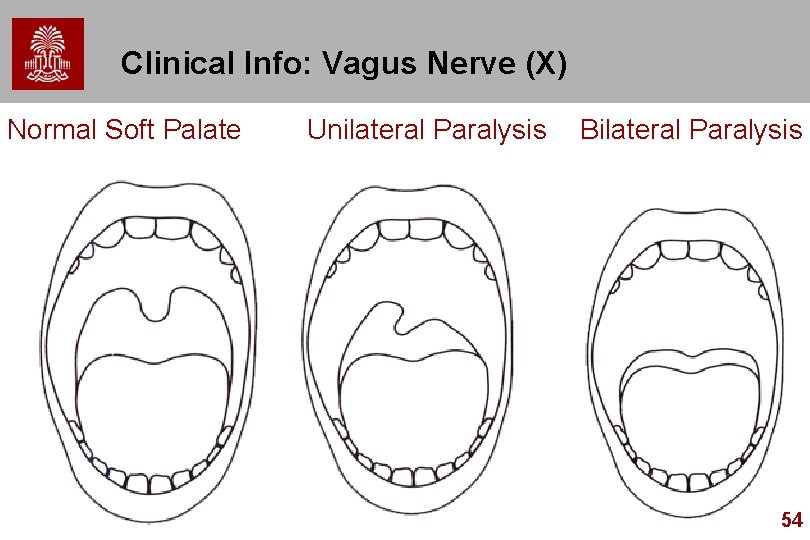 Clinical Info: Vagus Nerve (X) Normal Soft Palate Unilateral Paralysis Bilateral Paralysis 54 