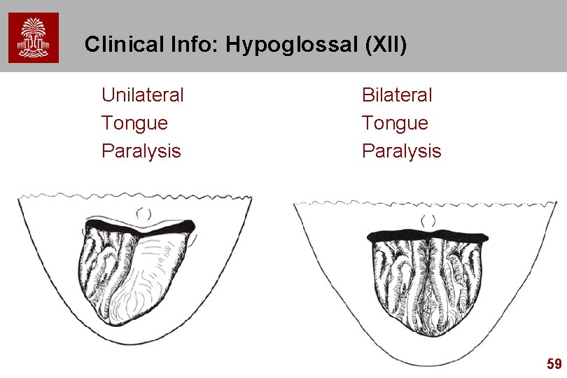 Clinical Info: Hypoglossal (XII) Unilateral Tongue Paralysis Bilateral Tongue Paralysis 59 