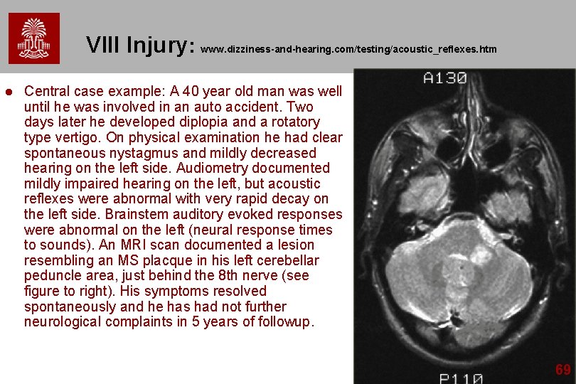 VIII Injury: www. dizziness-and-hearing. com/testing/acoustic_reflexes. htm l Central case example: A 40 year old