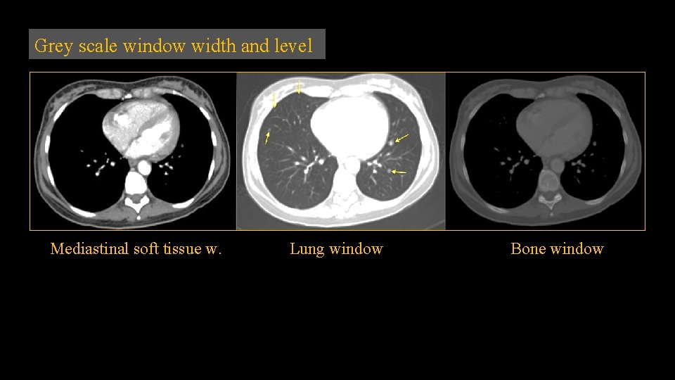 Grey scale window width and level Mediastinal soft tissue w. Lung window Bone window