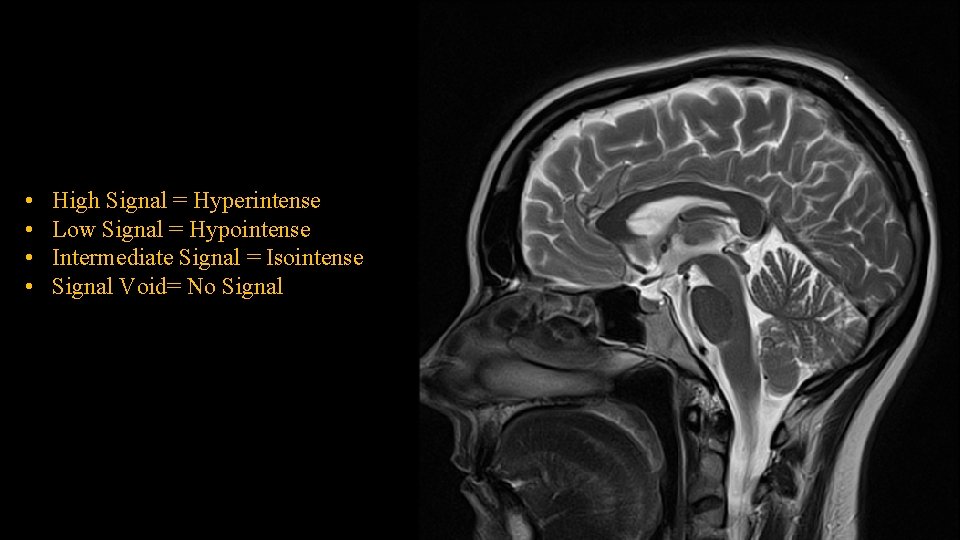  • • High Signal = Hyperintense Low Signal = Hypointense Intermediate Signal =