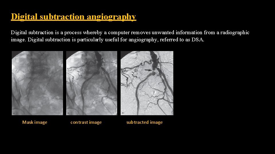 Digital subtraction angiography Digital subtraction is a process whereby a computer removes unwanted information Digital subtraction angiography Digital subtraction is a process whereby a computer removes unwanted information