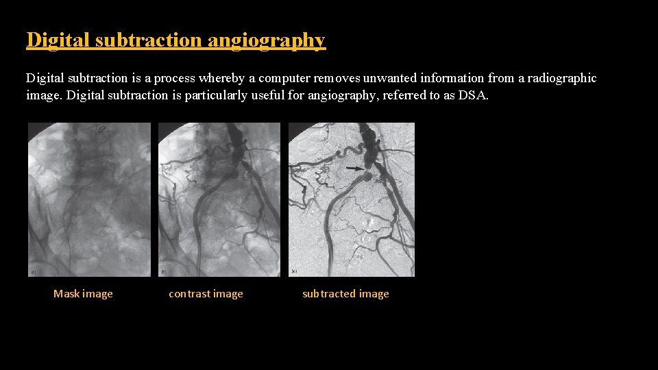 Digital subtraction angiography Digital subtraction is a process whereby a computer removes unwanted information