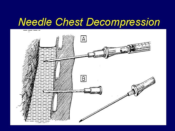 Needle Chest Decompression 