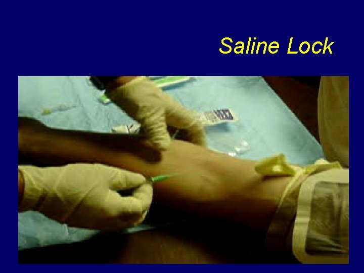 Saline Lock 