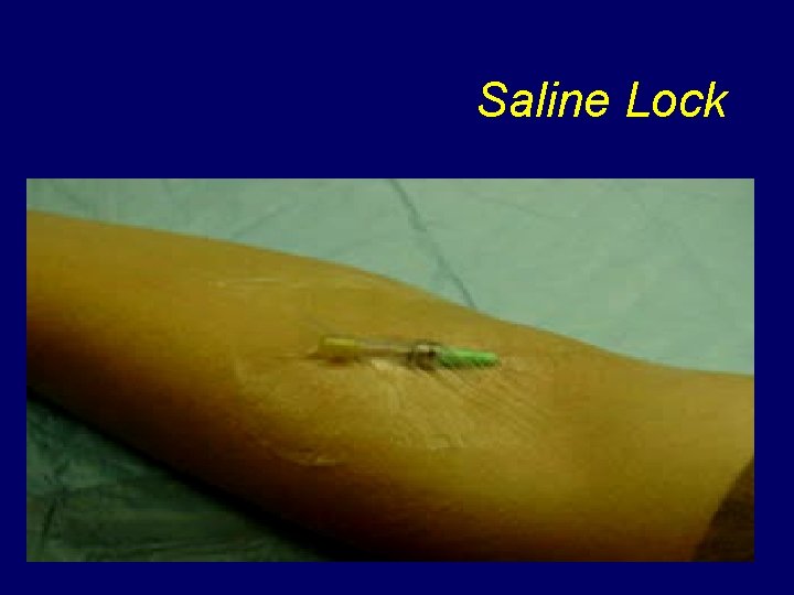 Saline Lock 
