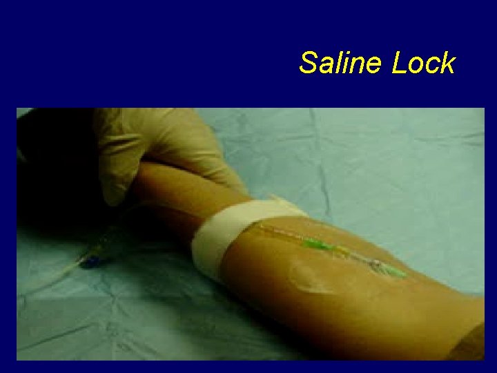 Saline Lock 