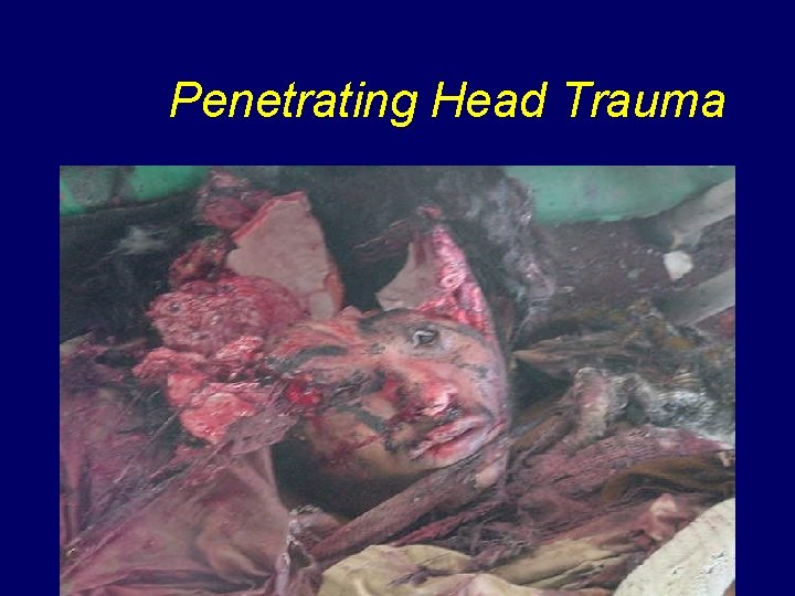Penetrating Head Trauma 