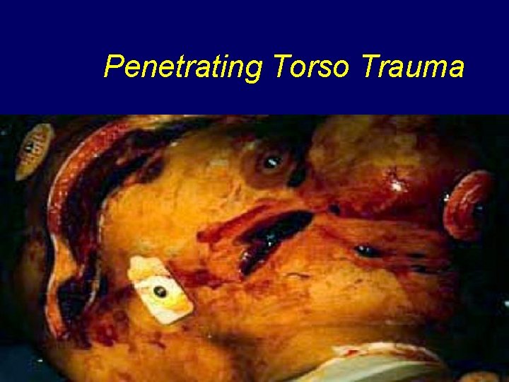 Penetrating Torso Trauma 