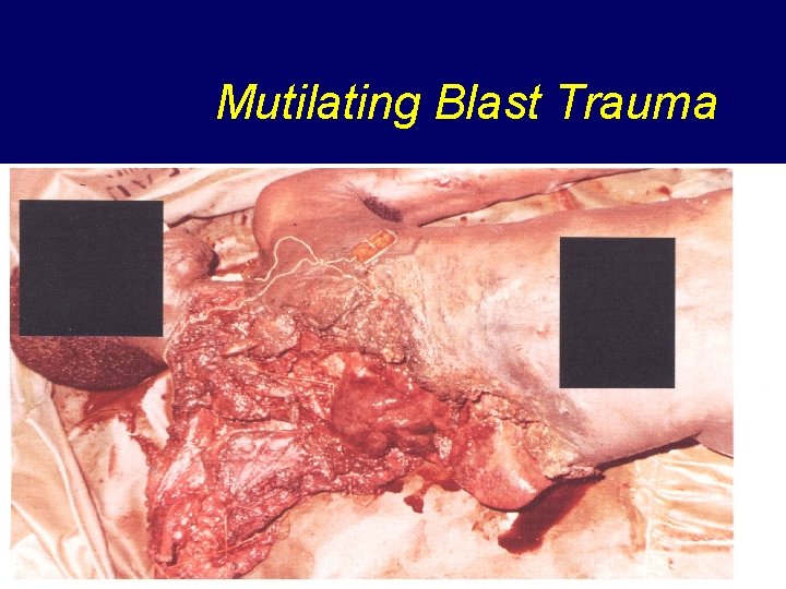 Mutilating Blast Trauma 