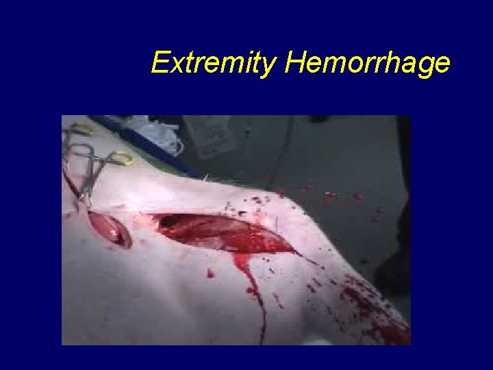 Extremity Hemorrhage 