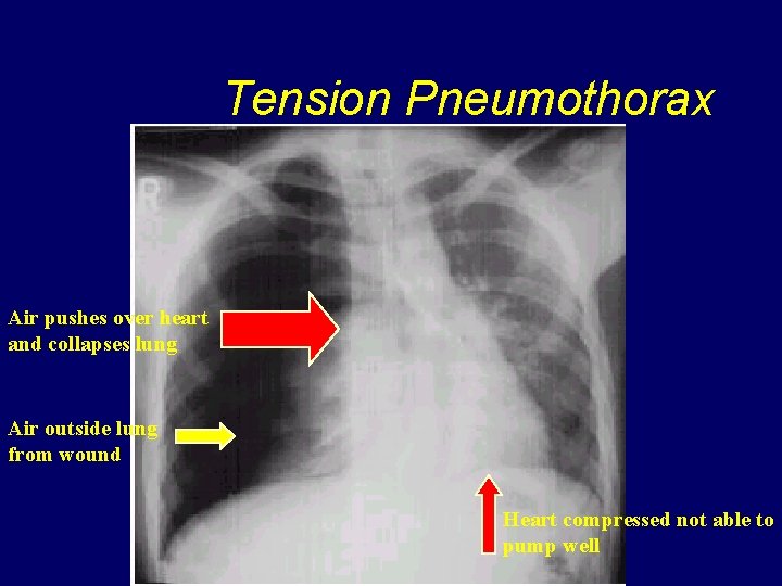 Tension Pneumothorax Air pushes over heart and collapses lung Air outside lung from wound