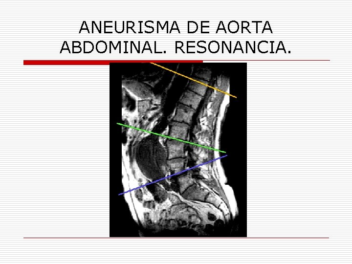 ANEURISMA DE AORTA ABDOMINAL. RESONANCIA. 