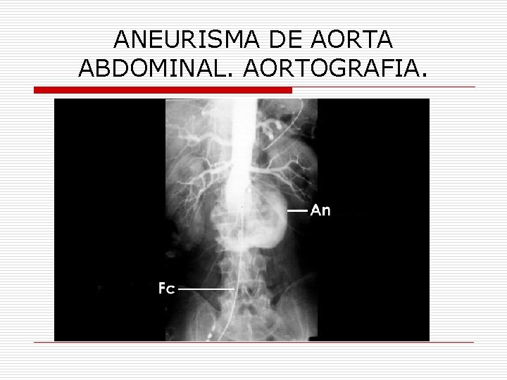 ANEURISMA DE AORTA ABDOMINAL. AORTOGRAFIA. 