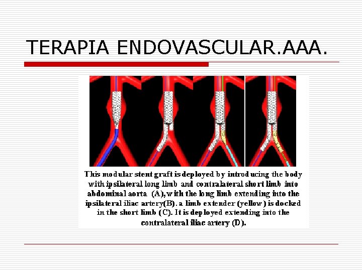 TERAPIA ENDOVASCULAR. AAA. 