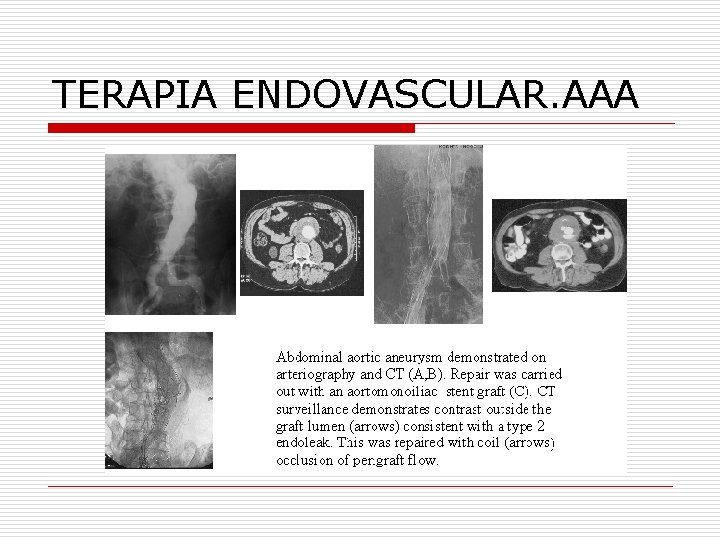 TERAPIA ENDOVASCULAR. AAA 