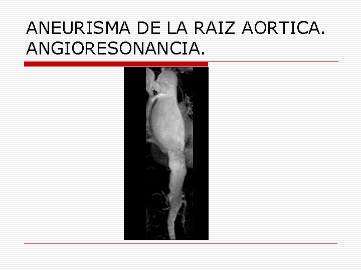 ANEURISMA DE LA RAIZ AORTICA. ANGIORESONANCIA. 