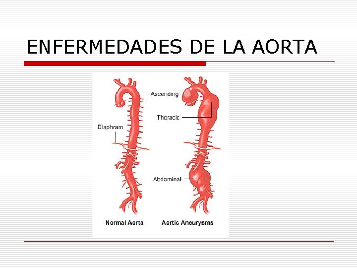 ENFERMEDADES DE LA AORTA 