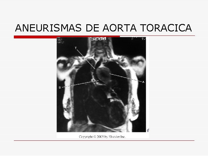 ANEURISMAS DE AORTA TORACICA 