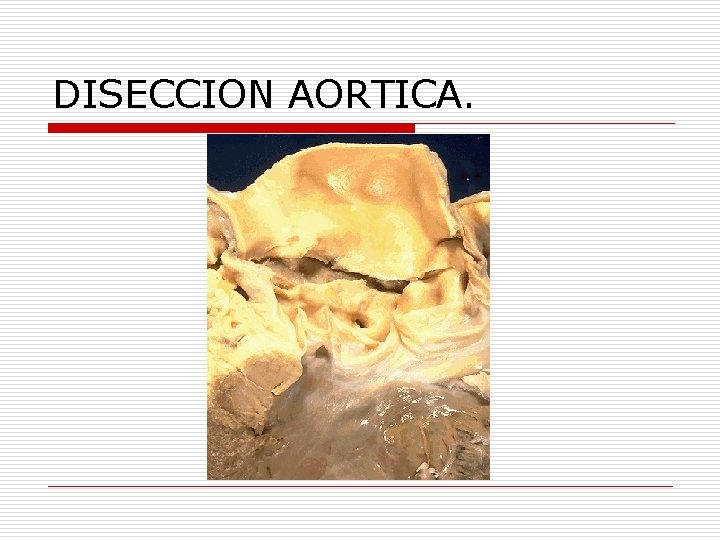 DISECCION AORTICA. 