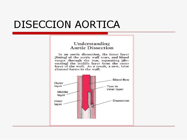 DISECCION AORTICA 