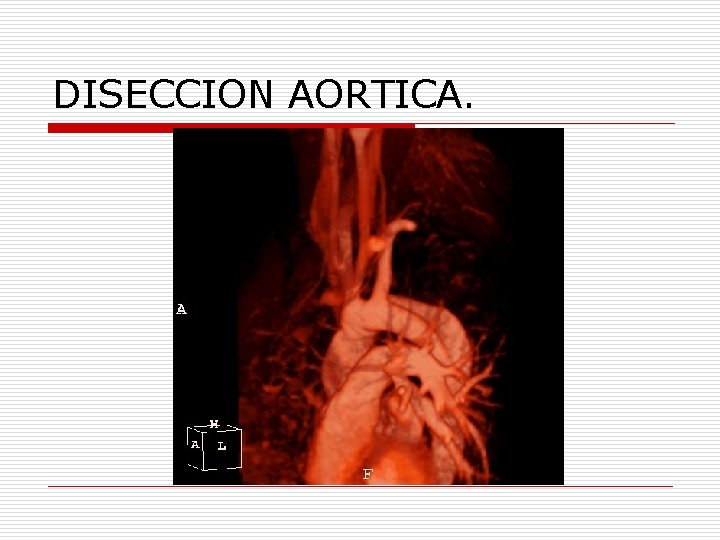 DISECCION AORTICA. 
