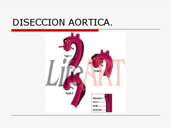 DISECCION AORTICA. 