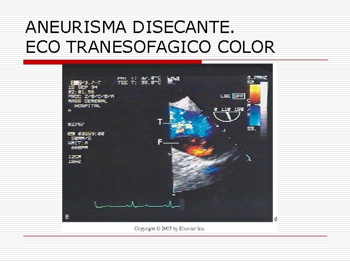 ANEURISMA DISECANTE. ECO TRANESOFAGICO COLOR 