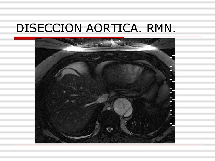 DISECCION AORTICA. RMN. 