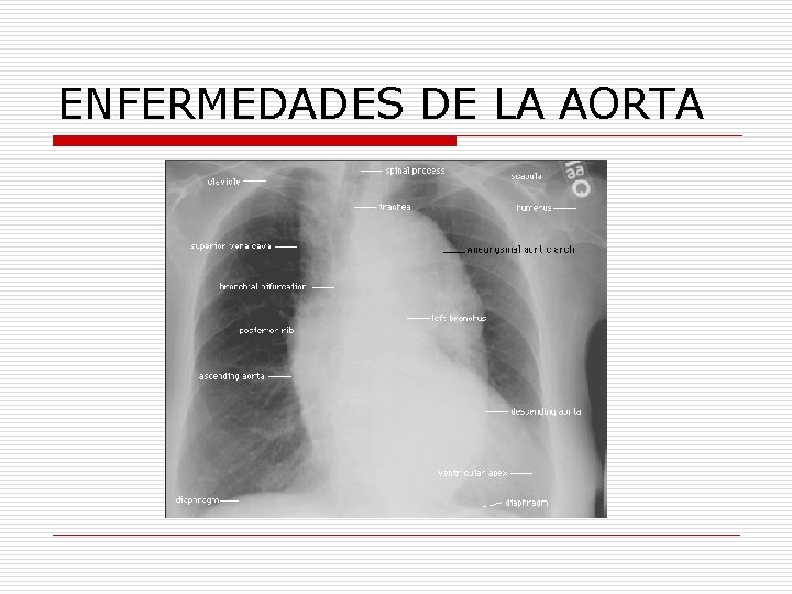 ENFERMEDADES DE LA AORTA 