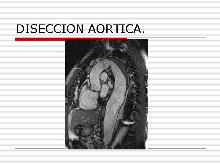 DISECCION AORTICA. 