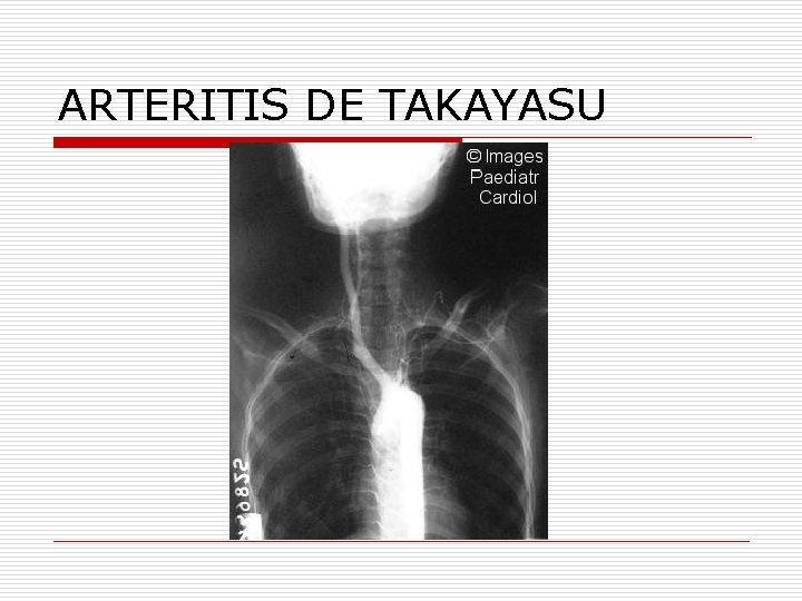 ARTERITIS DE TAKAYASU 