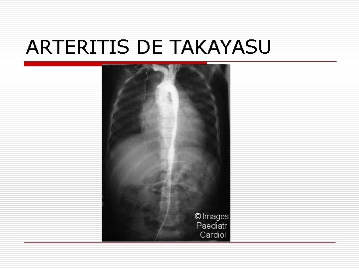 ARTERITIS DE TAKAYASU 