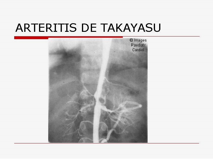 ARTERITIS DE TAKAYASU 