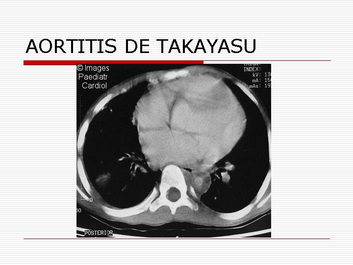 AORTITIS DE TAKAYASU 