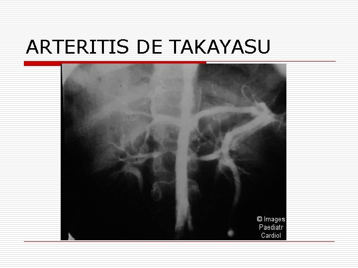 ARTERITIS DE TAKAYASU 