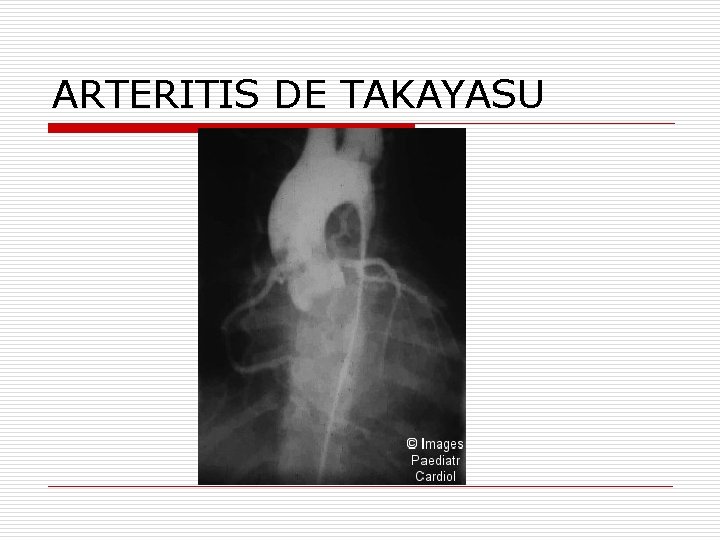 ARTERITIS DE TAKAYASU 