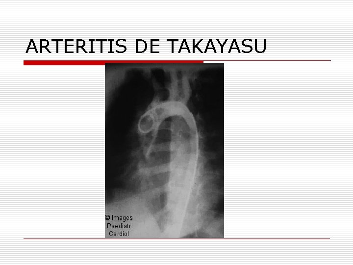 ARTERITIS DE TAKAYASU 