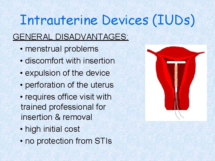 Intrauterine Devices (IUDs) GENERAL DISADVANTAGES: • menstrual problems • discomfort with insertion • expulsion