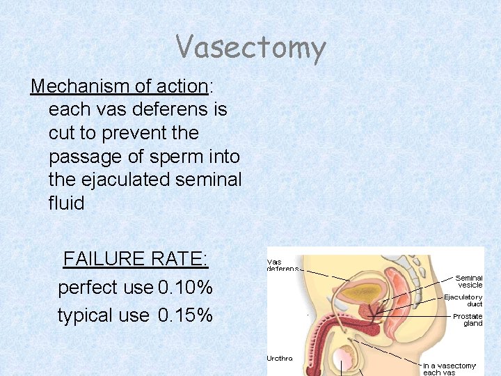 Vasectomy Mechanism of action: each vas deferens is cut to prevent the passage of